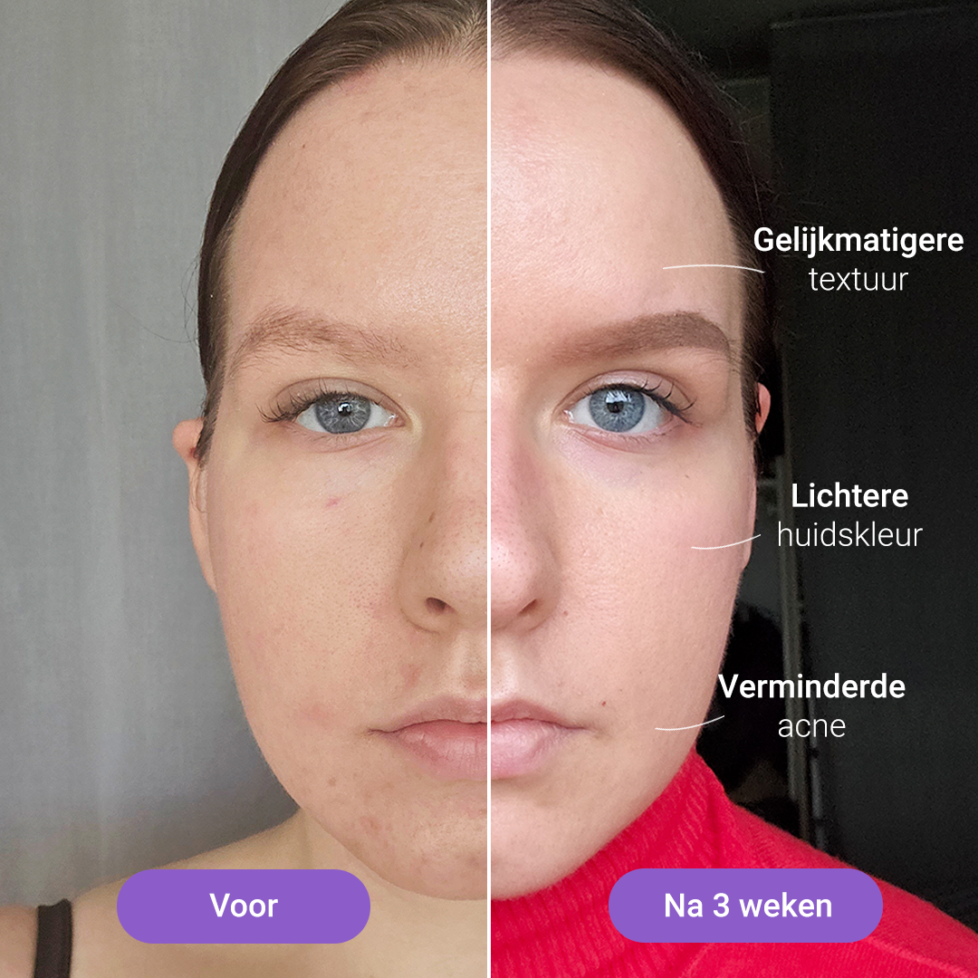 Lichttherapiemasker Lumi